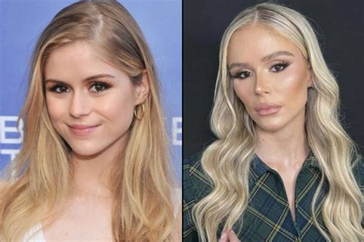 Has The Bachelorette’s Gabby Windey Done Plastic Surgery? Explore Her Before And After Photos