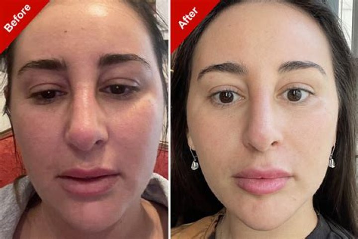 
Ian Thorpe Before And After Photos – Has He Had A Nose Job? 