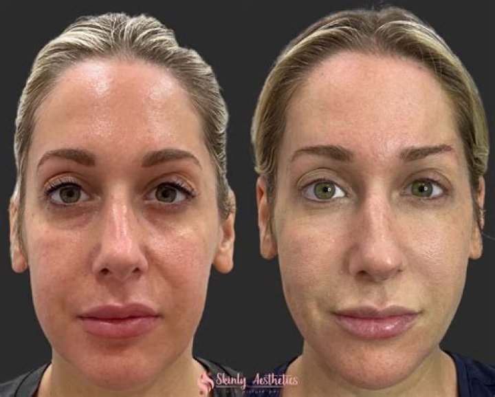Kristin Davis Lips: Before And After Fillers -Everything On Her Cosmetic Surgery