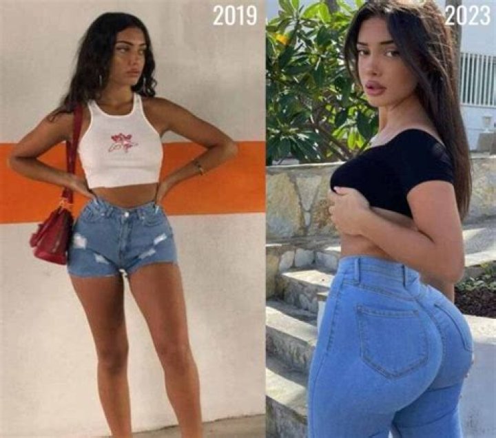 Melimtx Before Surgery: Plastic Surgery Transformation