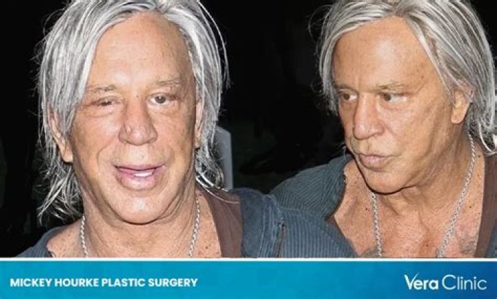 Mickey Rourke Before And After Photos And Plastic Surgery 2023